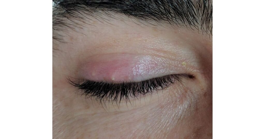 8 Ways of How to get rid of a stye